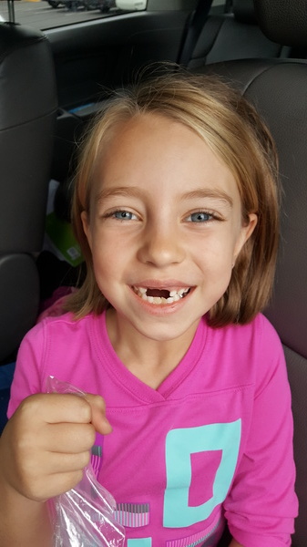 Lost Another Tooth